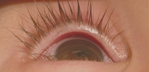 Distichiasis