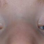 Congenital Fibrosis of the Extraocular Muscles