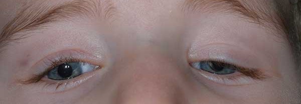 Congenital Fibrosis of the Extraocular Muscles: A Nerve Problem Wearing a Muscle Name