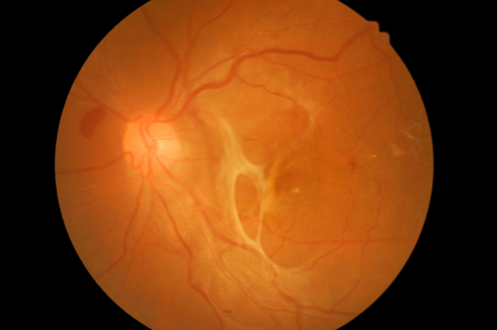 Tractional Retinal Detachment