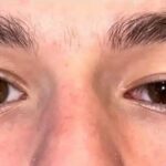 Blepharoptosis Surgery