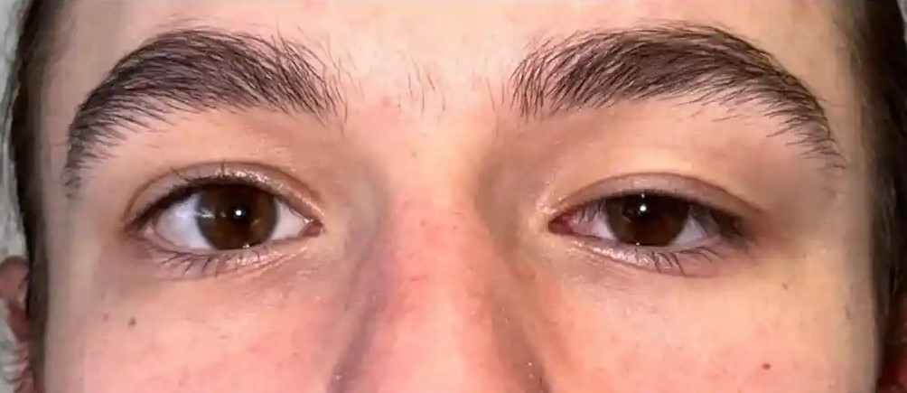 Blepharoptosis Surgery: Matching the Technique to the Levator’s Function