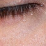 Molluscum Contagiosum