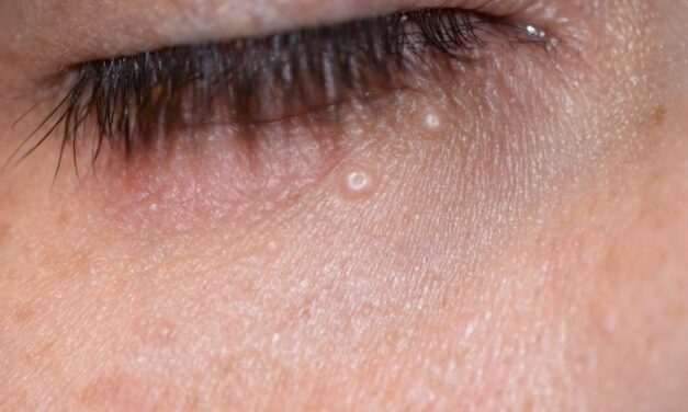 Molluscum Contagiosum: The Eyelid Bump Behind a Stubborn Red Eye