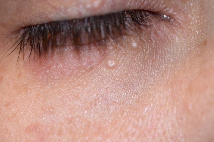 Molluscum Contagiosum: The Eyelid Bump Behind a Stubborn Red Eye