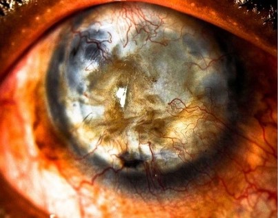 Boston Keratoprosthesis: The Artificial Cornea for Eyes Out of Other Options