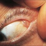 Lacrimal Gland Tumors