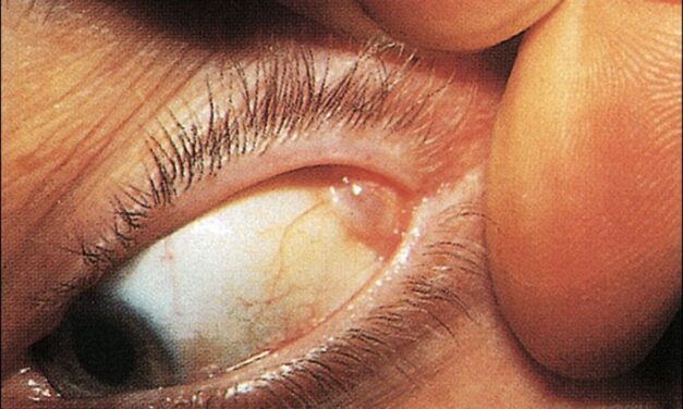 Lacrimal Gland Tumors: What Pace and Pain Tell You Before Biopsy