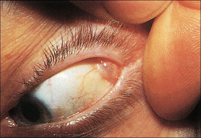 Lacrimal Gland Tumors: What Pace and Pain Tell You Before Biopsy