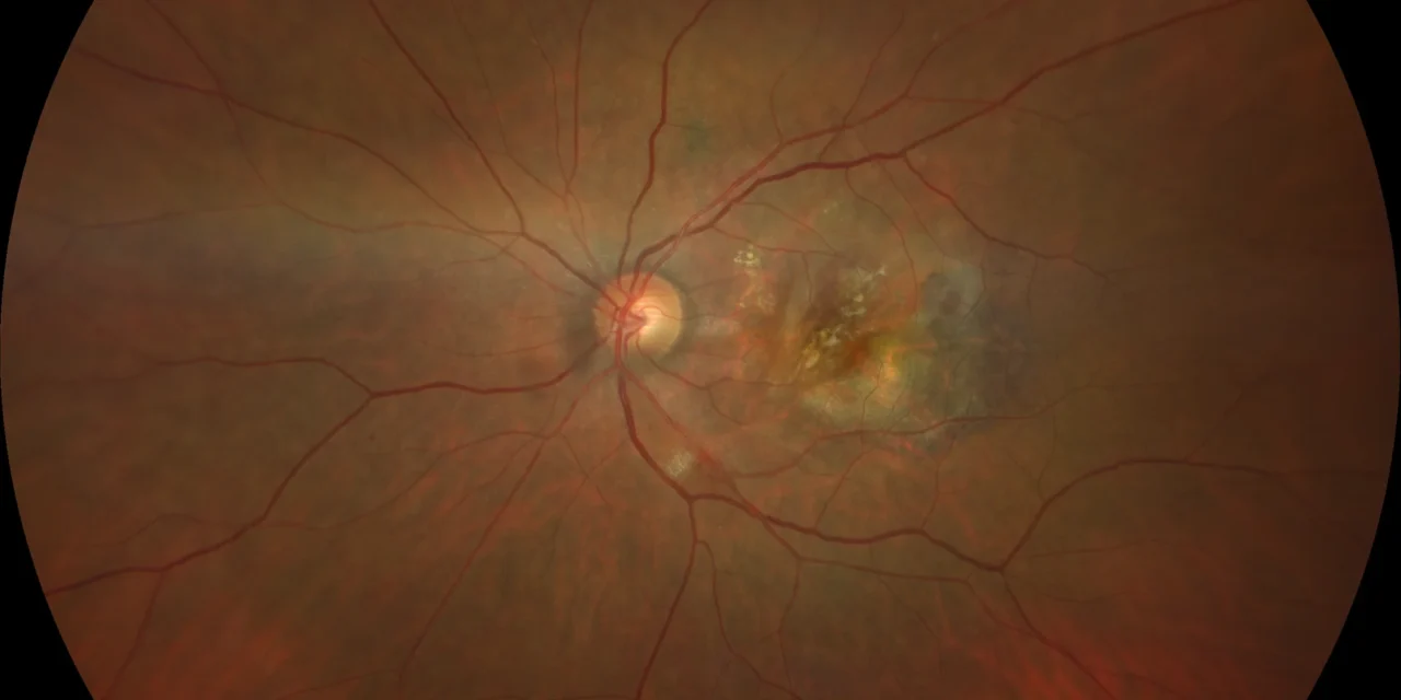 RPE Tear: When Treating the PED Successfully Backfires