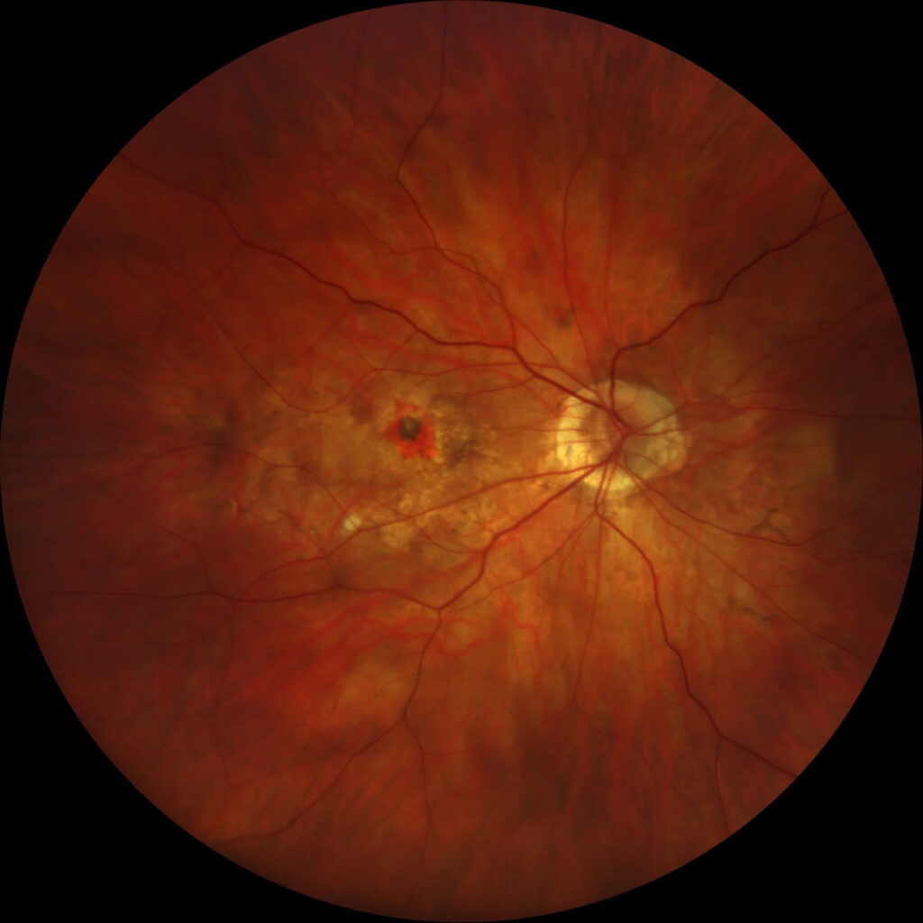 Myopic Choroidal Neovascularization