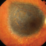 Choroidal Melanoma