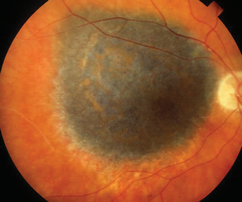 Choroidal Melanoma