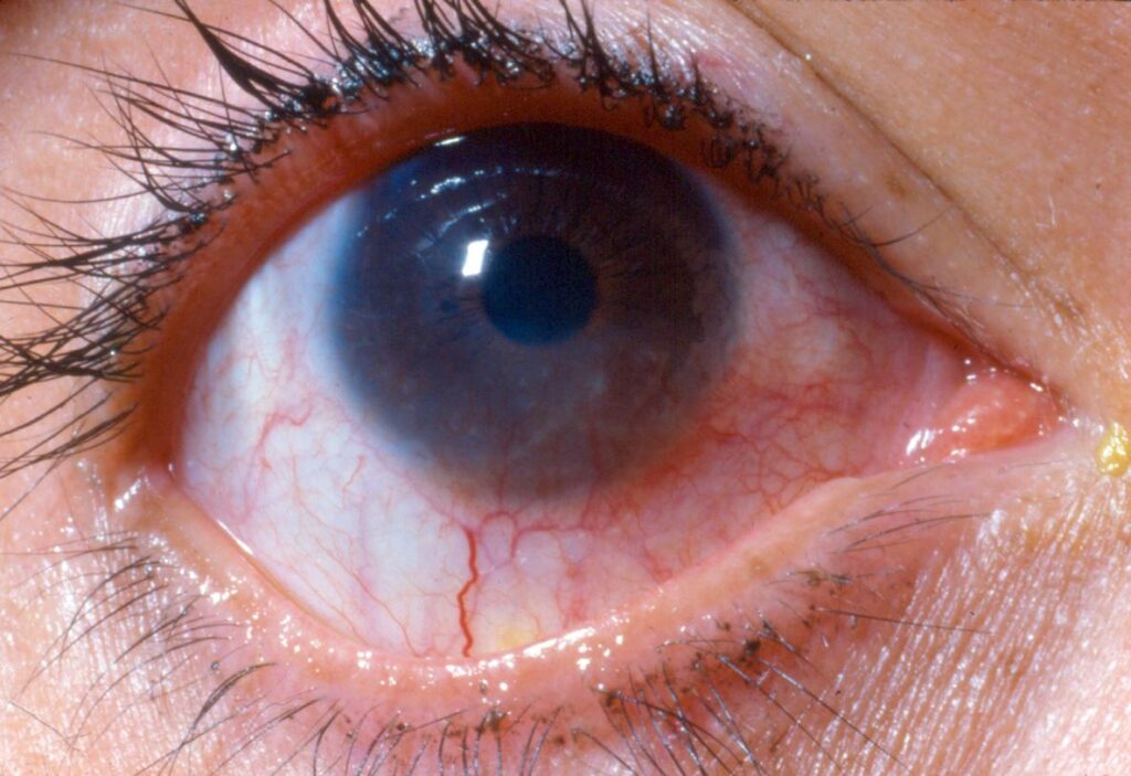 Phlyctenular Keratoconjunctivitis