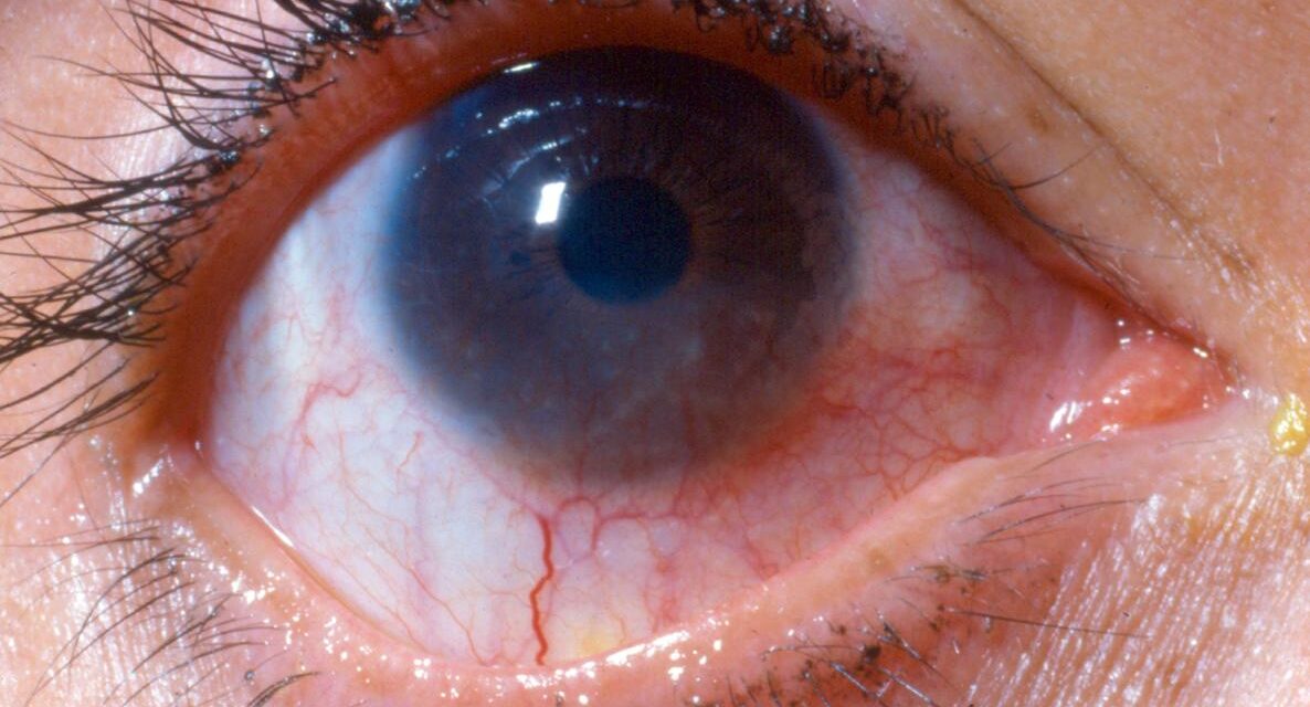 Phlyctenular Keratoconjunctivitis: A Hypersensitivity Reaction at the Limbus