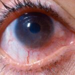 Phlyctenular Keratoconjunctivitis