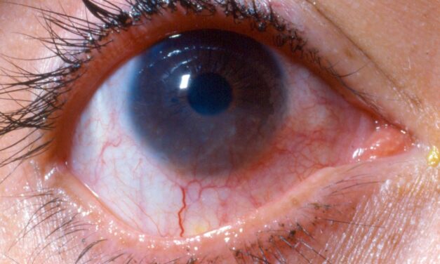 Phlyctenular Keratoconjunctivitis: A Hypersensitivity Reaction at the Limbus
