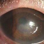 Corneal Melt