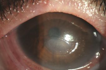 Corneal Melt: When Thinning Isn’t From Infection at All