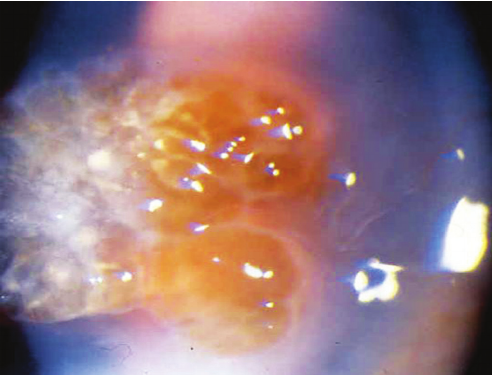 Climatic Droplet Keratopathy