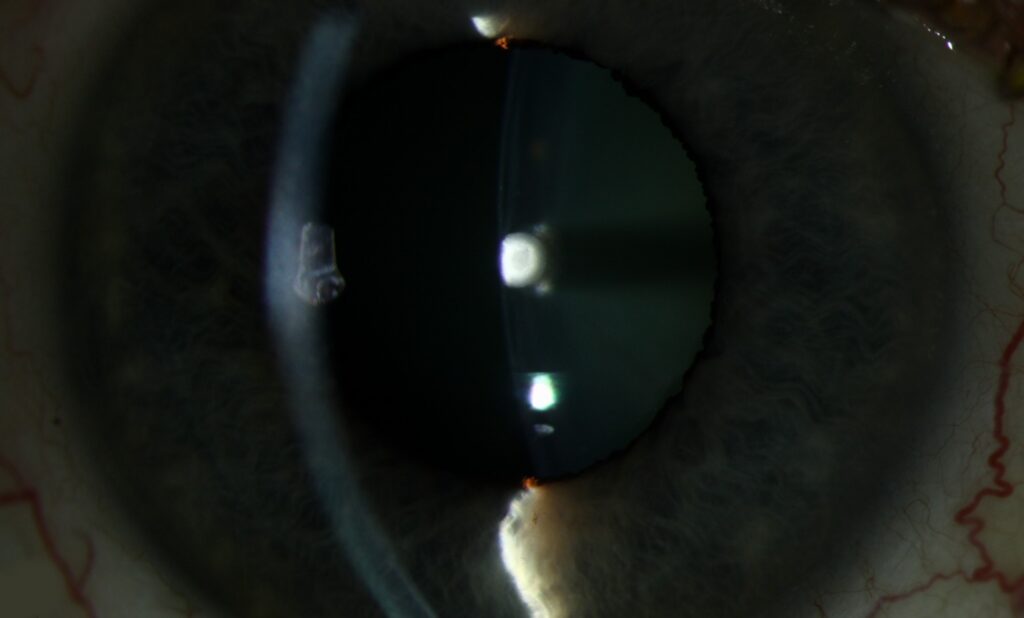 Anterior Polar Cataract