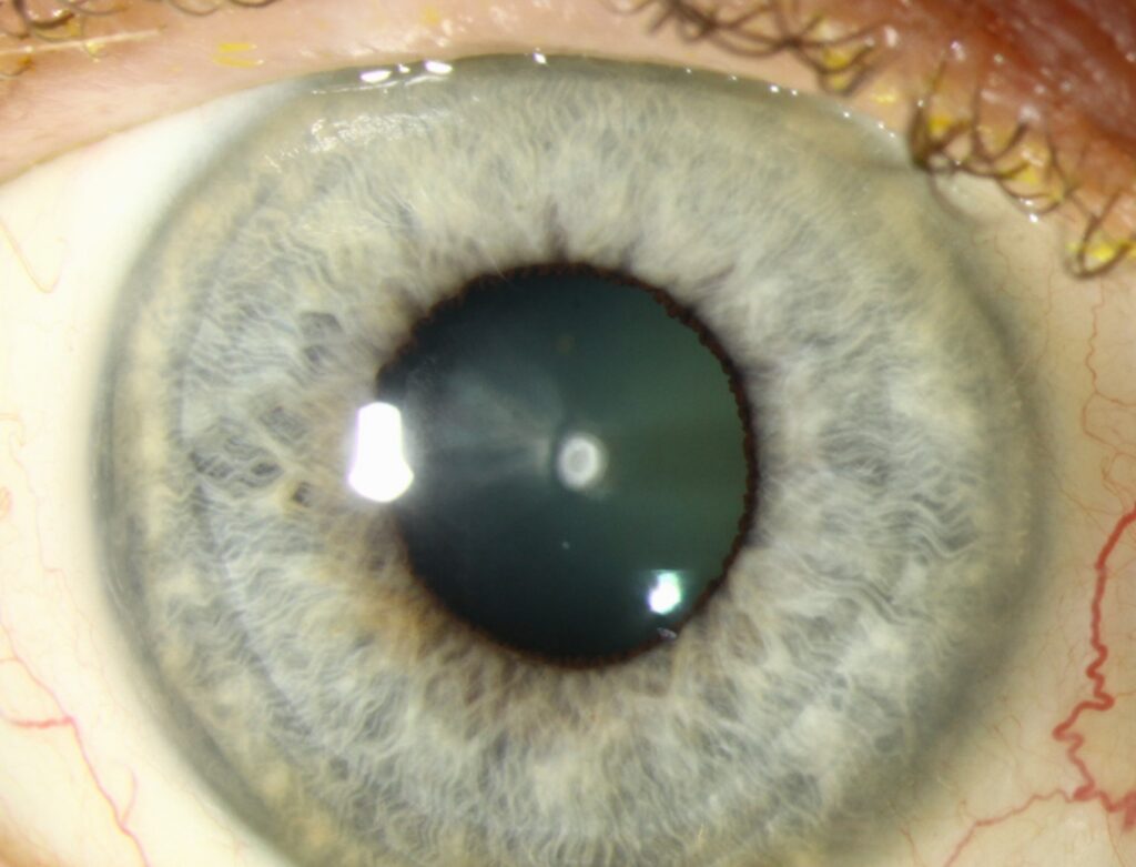 Anterior Polar Cataract