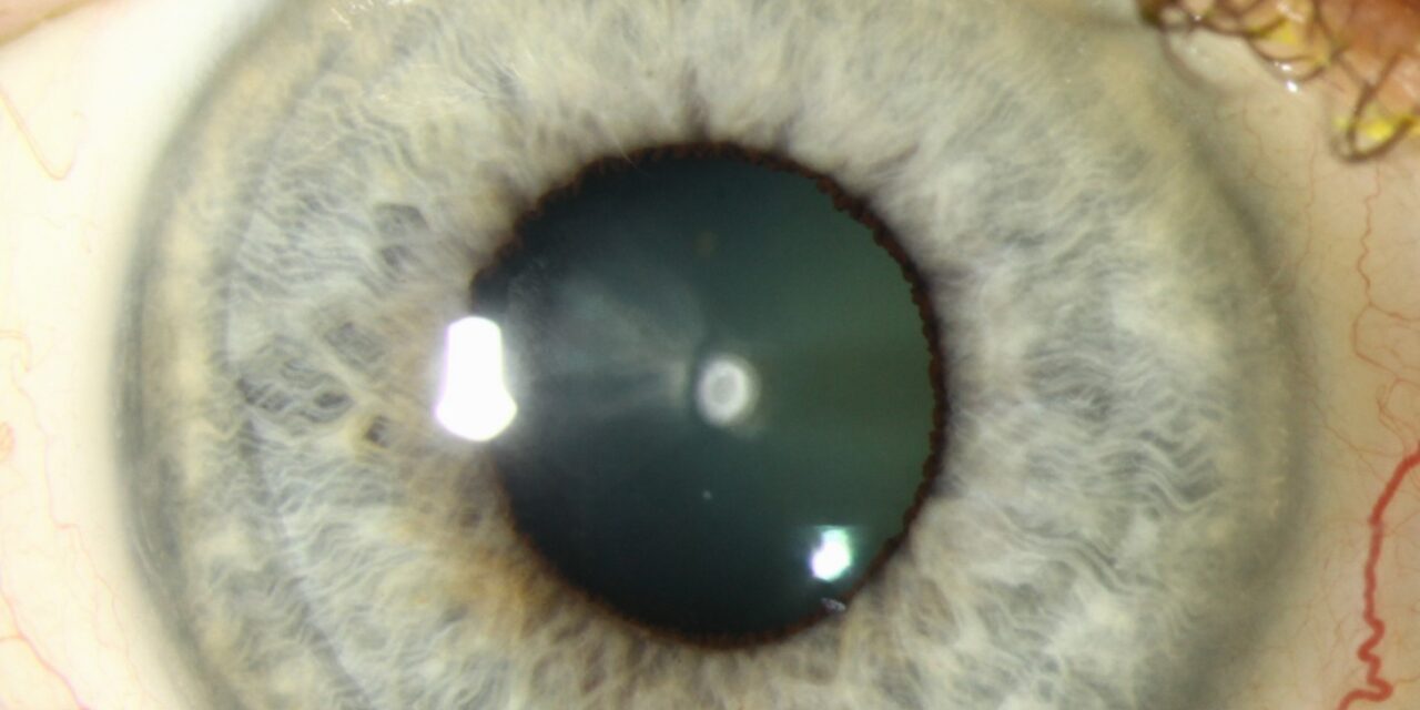 Anterior Polar Cataract: Small, Stable, and Usually Benign