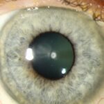 Anterior Polar Cataract