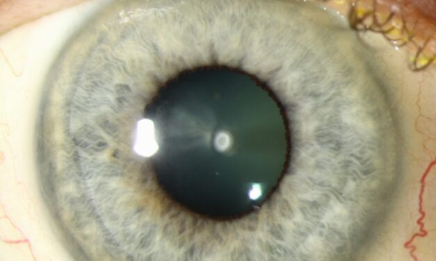 Anterior Polar Cataract: Small, Stable, and Usually Benign