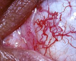 Clinical eye photograph illustrating Ataxia Telangiectasia Ocular Findings