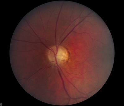 Dominant Optic Atrophy