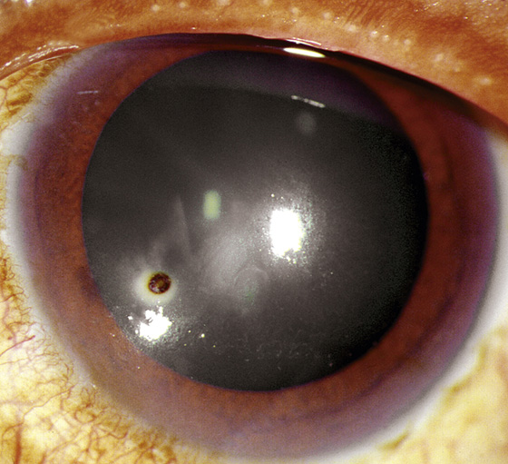 Corneal Foreign Body: When History Matters More Than the Exam