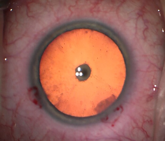 Posterior Polar Cataract