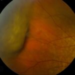 Choroidal Detachment