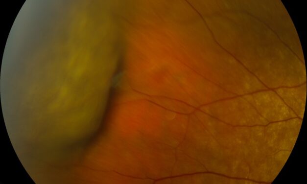 Choroidal Detachment: Serous Hypotony vs. Suprachoroidal Hemorrhage