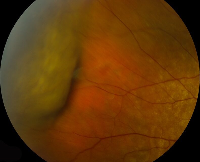 Choroidal Detachment: Serous Hypotony vs. Suprachoroidal Hemorrhage