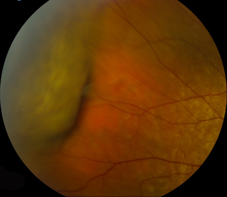 Choroidal Detachment
