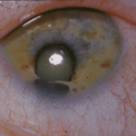 Cat Eye Syndrome