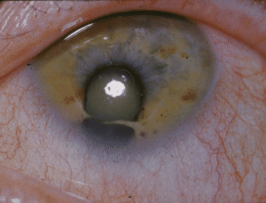 Cat Eye Syndrome