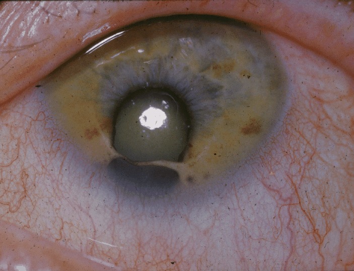 Cat Eye Syndrome: The Chromosome 22 Disorder Behind the Coloboma