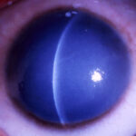 Congenital Hereditary Endothelial Dystrophy