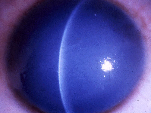 Congenital Hereditary Endothelial Dystrophy: Cloudy Corneas Without Glaucoma