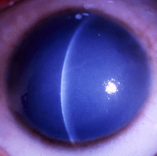 Congenital Hereditary Endothelial Dystrophy: Cloudy Corneas Without Glaucoma