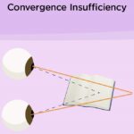 Convergence Insufficiency