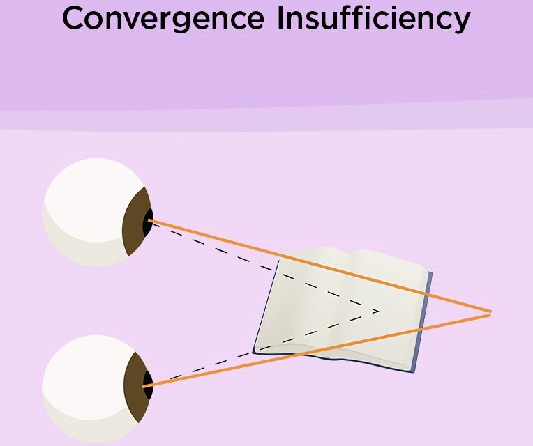Convergence Insufficiency: The Reading Problem That Isn’t Attention