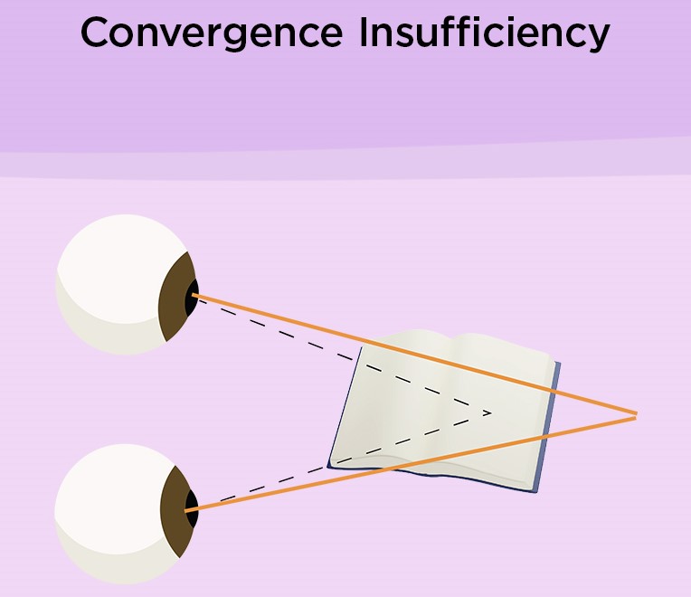 Convergence Insufficiency