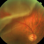Retinal Cryotherapy