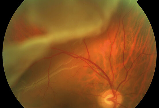 Retinal Cryotherapy: When Freezing Still Beats the Laser