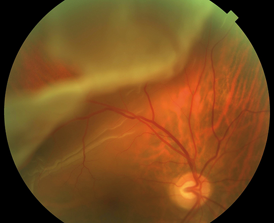 Retinal Cryotherapy: When Freezing Still Beats the Laser
