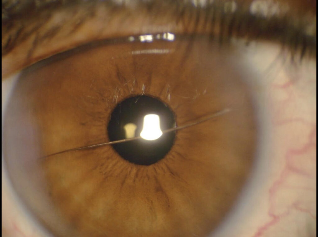 Corneal Foreign Body